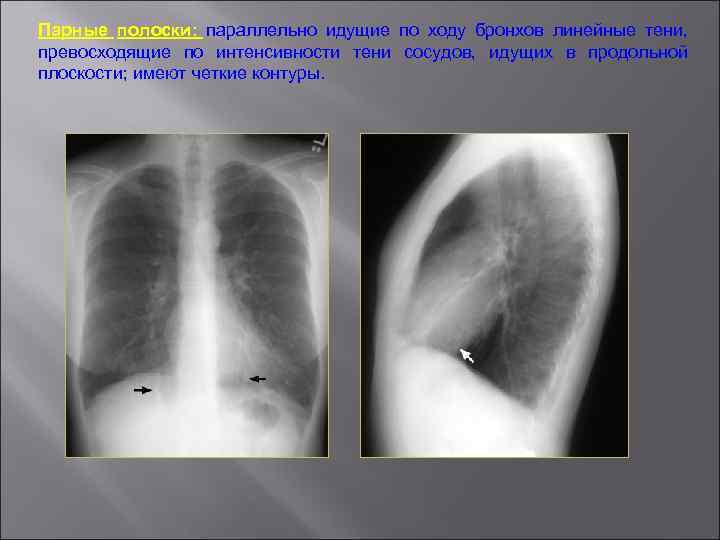 Парные полоски: параллельно идущие по ходу бронхов линейные тени, превосходящие по интенсивности тени сосудов,