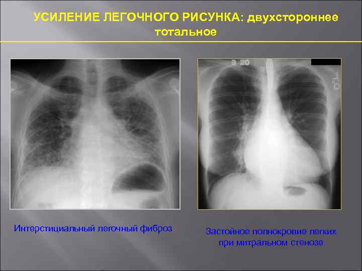 Сгущение легочного рисунка в нижних отделах легких что это