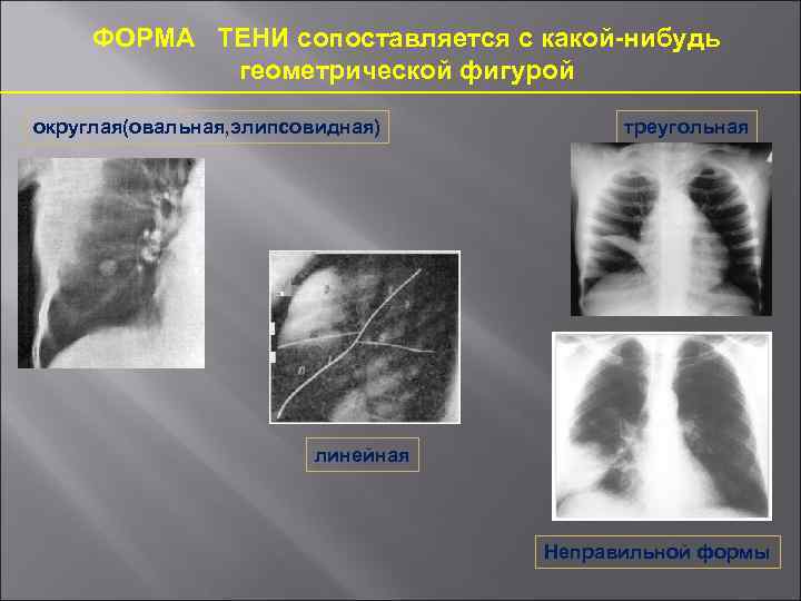 ФОРМА ТЕНИ сопоставляется с какой-нибудь геометрической фигурой округлая(овальная, элипсовидная) треугольная линейная Неправильной формы 