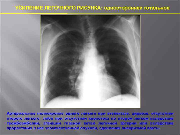 Легочный рисунок усилен в прикорневых отделах