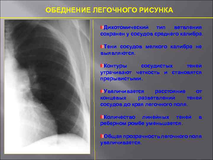 Обеднение легочного рисунка