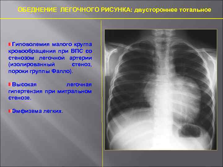 Обеднение сосудистого рисунка легких характерно для