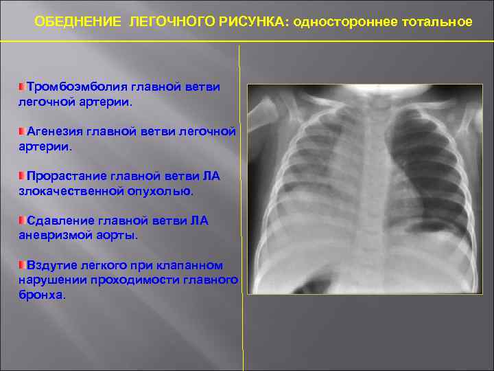 Обеднение сосудистого рисунка легких характерно для