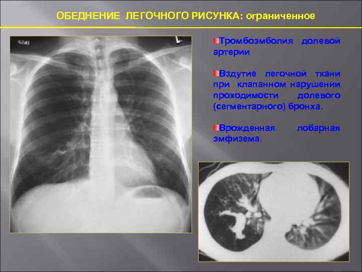 Обогащение легочного рисунка в прикорневой зоне