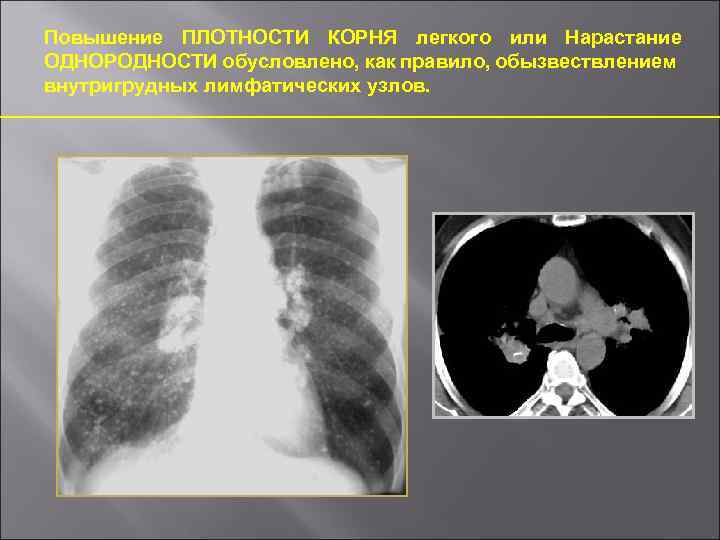 Рентгенологические синдромы легких
