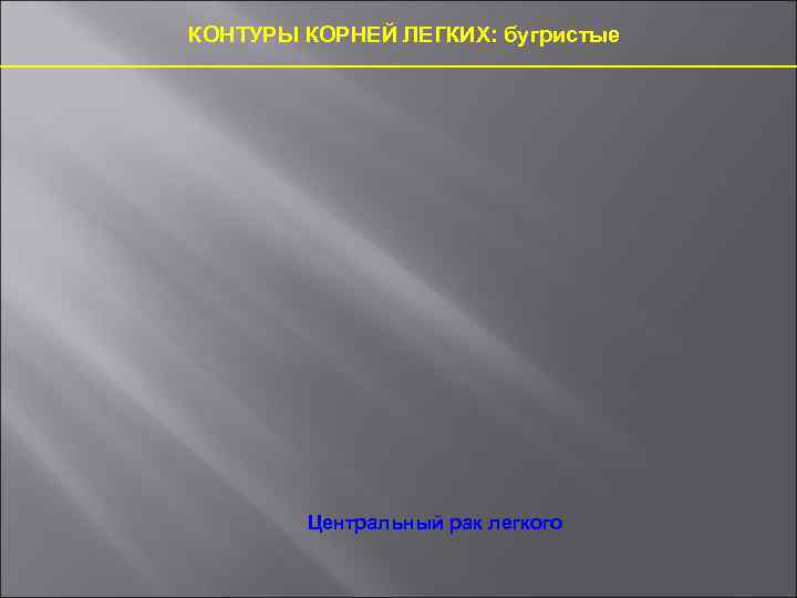 КОНТУРЫ КОРНЕЙ ЛЕГКИХ: бугристые Центральный рак легкого 