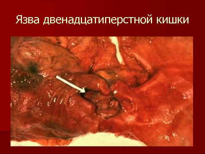 Язва двенадцатиперстной кишки 