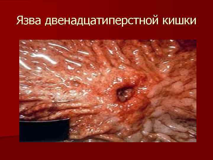 Язва двенадцатиперстной кишки 