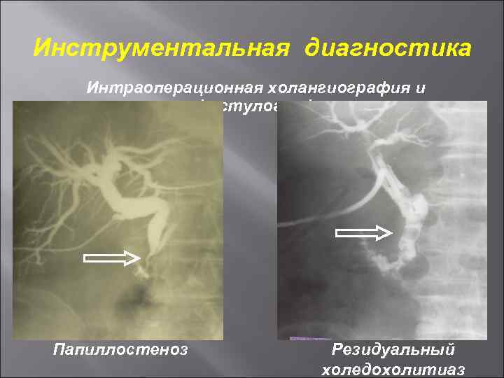 Инструментальная диагностика Интраоперационная холангиография и фистулография. Папиллостеноз Резидуальный холедохолитиаз 