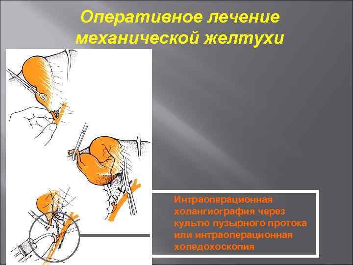 Оперативное лечение механической желтухи Интраоперационная холангиография через культю пузырного протока или интраоперационная холедохоскопия 