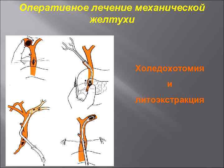 Оперативное лечение механической желтухи Холедохотомия и литоэкстракция 