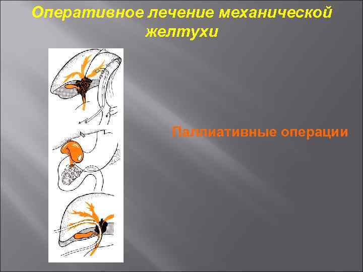 Оперативное лечение механической желтухи Паллиативные операции 