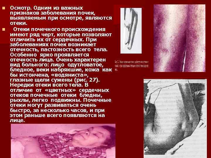 Осмотр. Одним из важных признаков заболевания почек, выявляемым при осмотре, являются отеки. n Отеки