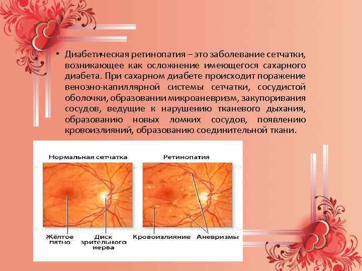 Диабетическая ретинопатия лечение