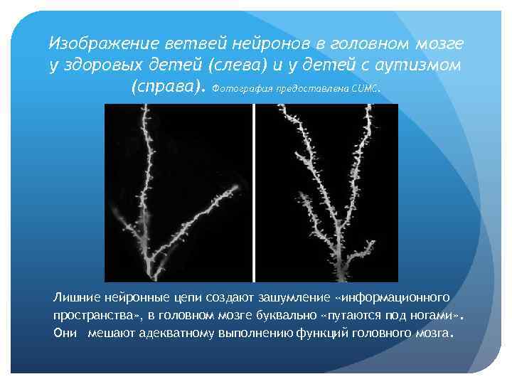 Изображение ветвей нейронов в головном мозге у здоровых детей (слева) и у детей с