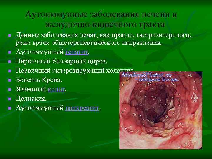 Аутоиммунные заболевания печени и желудочно-кишечного тракта n n n n Данные заболевания лечат, как