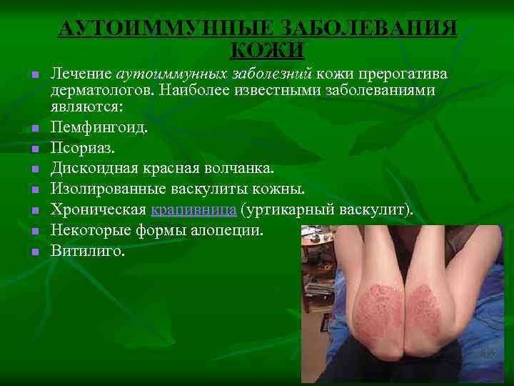 АУТОИММУННЫЕ ЗАБОЛЕВАНИЯ КОЖИ n n n n Лечение аутоиммунных заболезний кожи прерогатива дерматологов. Наиболее