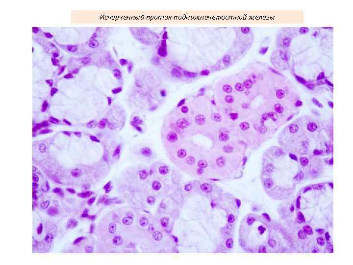 Исчерченный проток поднижнечелюстной железы 