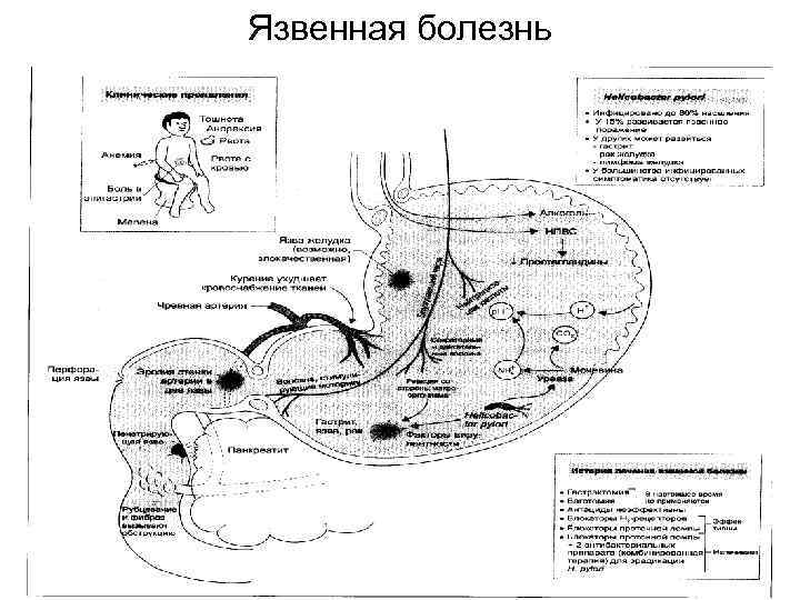 Язвенная болезнь 