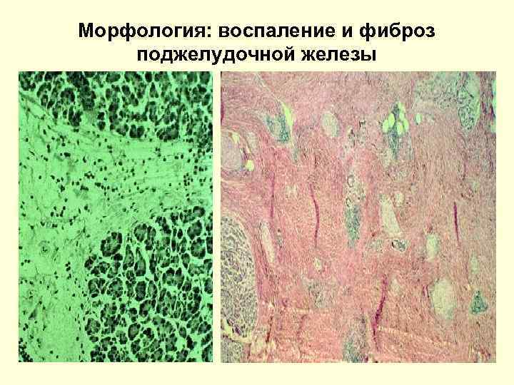 Морфология: воспаление и фиброз поджелудочной железы 