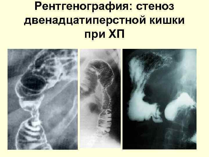 Рентгенография: стеноз двенадцатиперстной кишки при ХП 