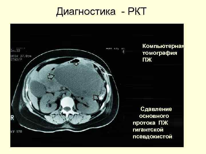 Диагностика - РКТ Компьютерная томография ПЖ Сдавление основного протока ПЖ гигантской псевдокистой 