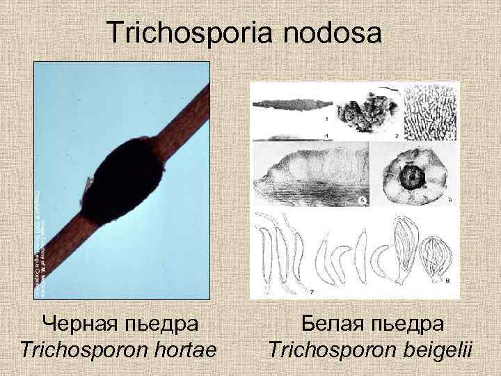 Trichosporia nodosa Черная пьедра Trichosporon hortae Белая пьедра Trichosporon beigelii 