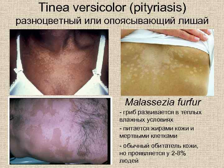 Tinea versicolor (pityriasis) разноцветный или опоясывающий лишай Malassezia furfur - гриб развивается в теплых