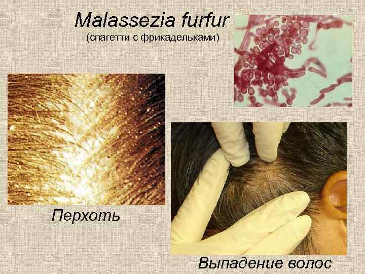 Malassezia furfur (спагетти с фрикадельками) Перхоть Выпадение волос 