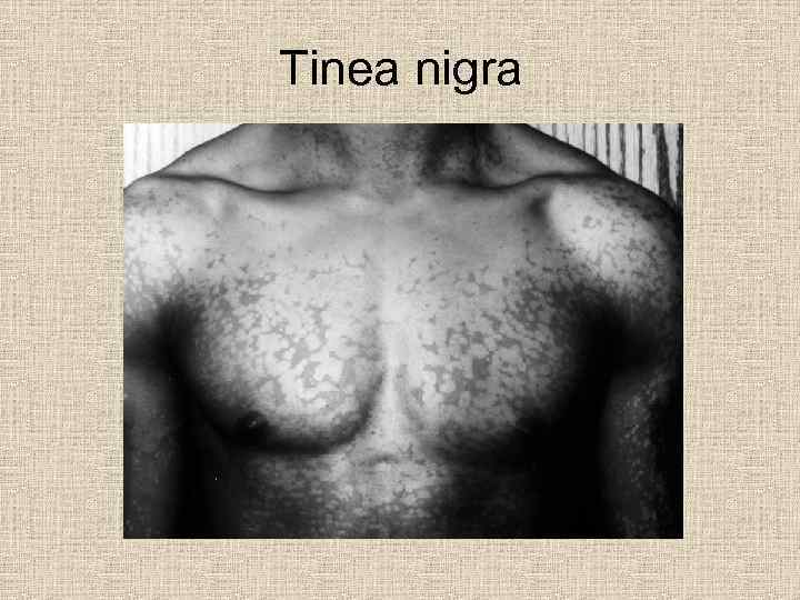 Tinea nigra 
