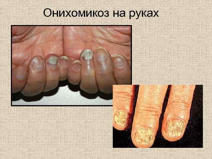 Онихомикоз на руках фото