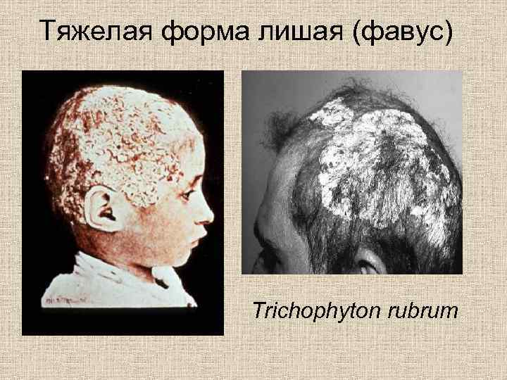 Тяжелая форма лишая (фавус) Trichophyton rubrum 