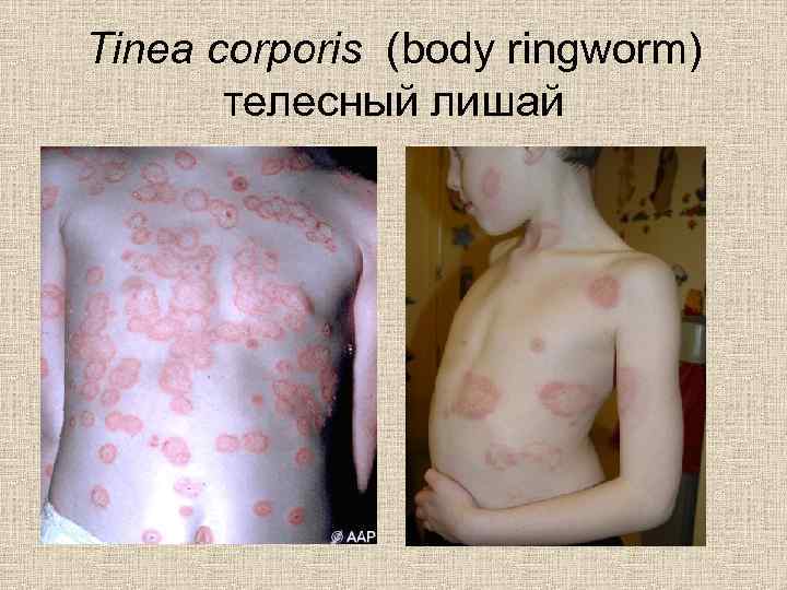 Tinea corporis (body ringworm) телесный лишай 
