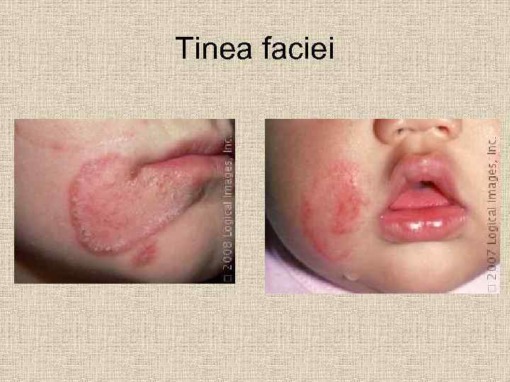 Tinea faciei 