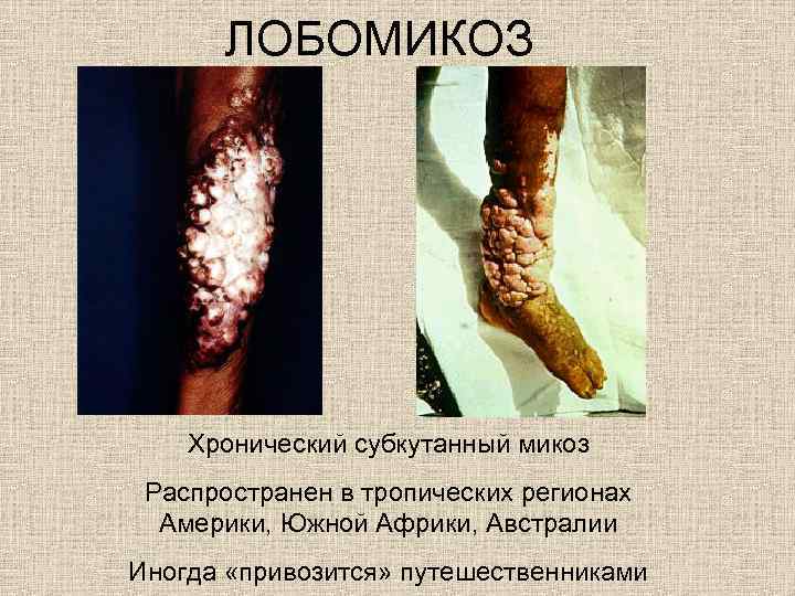 ЛОБОМИКОЗ Хронический субкутанный микоз Распространен в тропических регионах Америки, Южной Африки, Австралии Иногда «привозится»