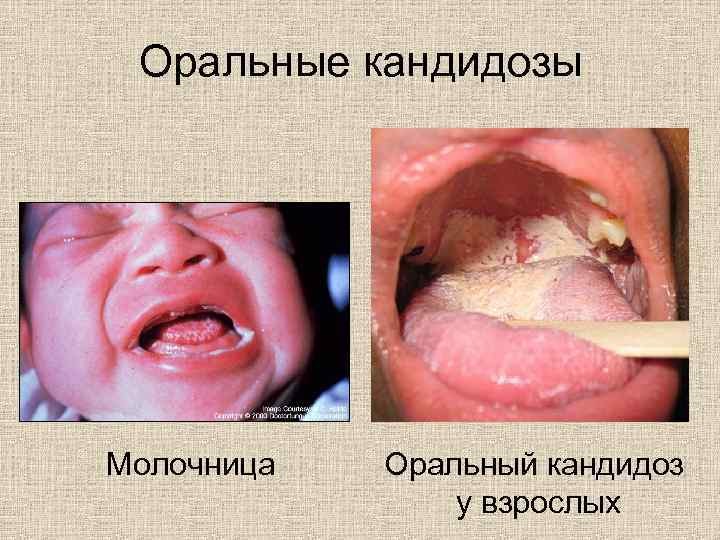 Оральные кандидозы Молочница Оральный кандидоз у взрослых 