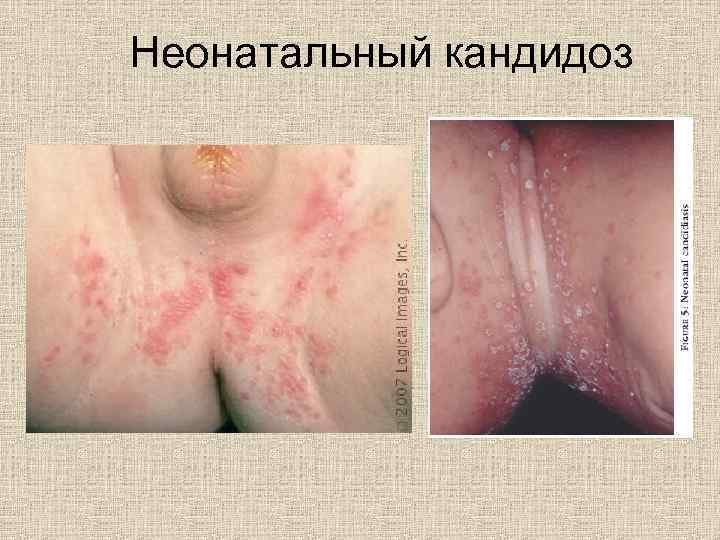 Неонатальный кандидоз 