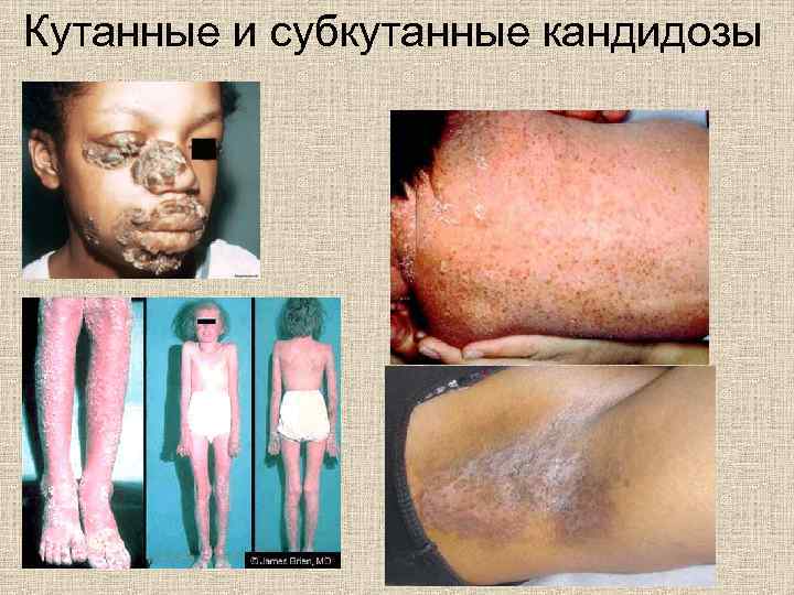 Кутанные и субкутанные кандидозы 