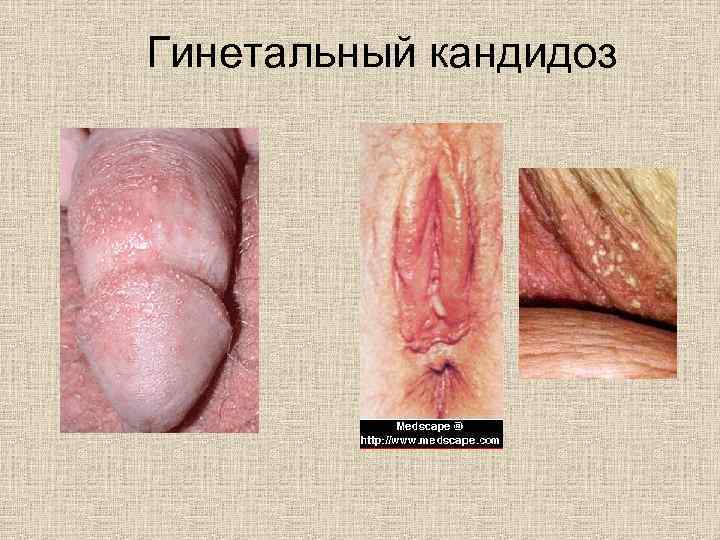 Гинетальный кандидоз 
