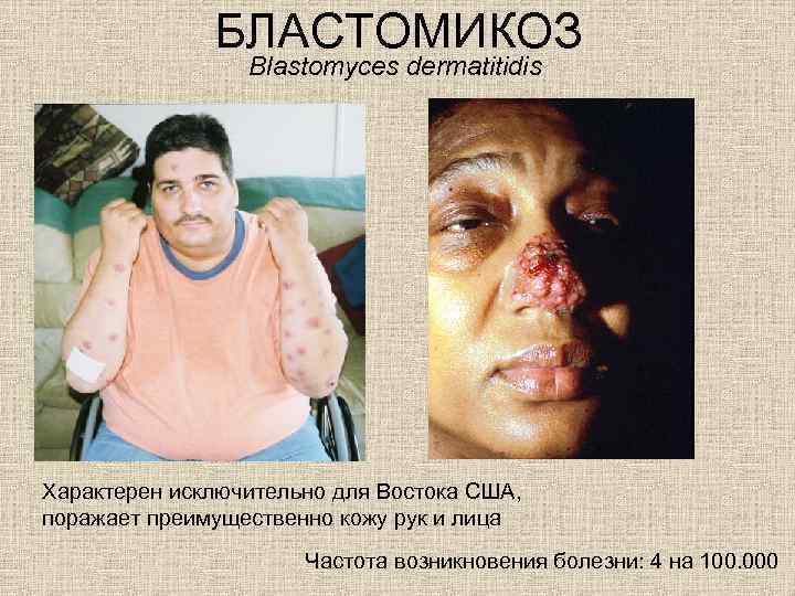 БЛАСТОМИКОЗ Blastomyces dermatitidis Характерен исключительно для Востока США, поражает преимущественно кожу рук и лица