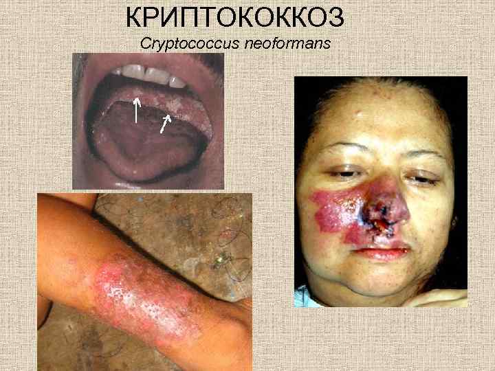 КРИПТОКОККОЗ Cryptococcus neoformans 