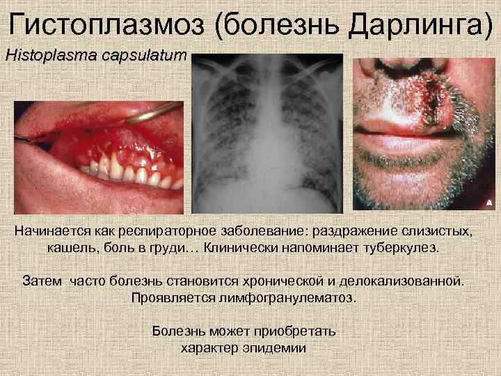 Гистоплазмоз (болезнь Дарлинга) Histoplasma capsulatum Начинается как респираторное заболевание: раздражение слизистых, кашель, боль в
