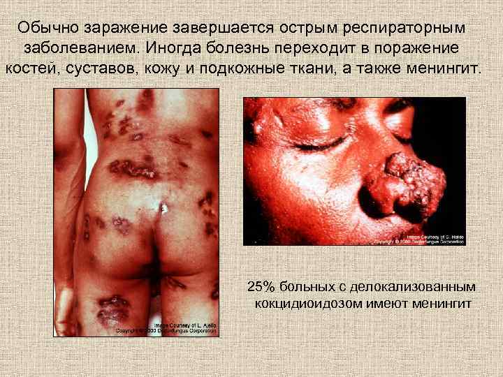 Обычно заражение завершается острым респираторным заболеванием. Иногда болезнь переходит в поражение костей, суставов, кожу