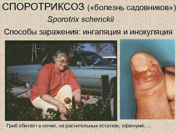 СПОРОТРИКСОЗ ( «болезнь садовников» ) Sporotrix schenckii Способы заражения: ингаляция и инокуляция Гриб обитает