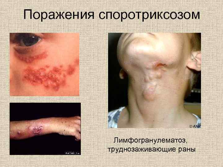 Поражения споротриксозом Лимфогранулематоз, труднозаживающие раны 