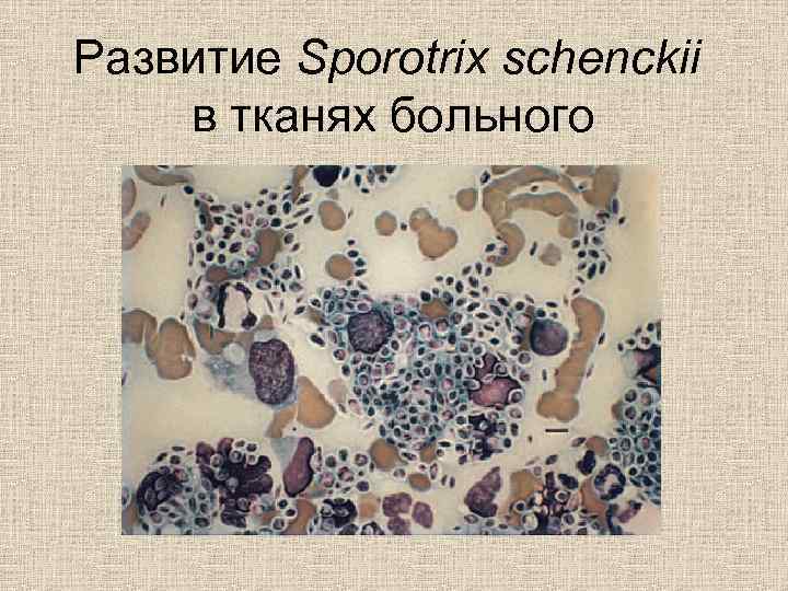 Развитие Sporotrix schenckii в тканях больного 