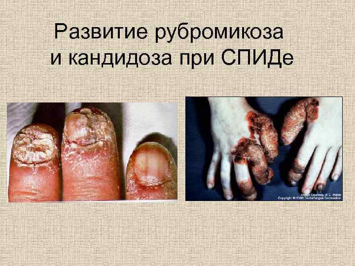 Развитие рубромикоза и кандидоза при СПИДе 