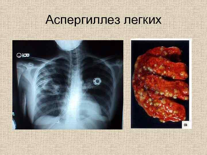 Аспергиллез легких 