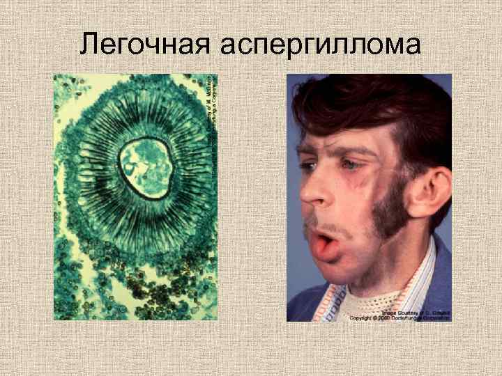 Легочная аспергиллома 