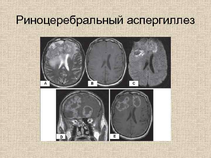 Риноцеребральный аспергиллез 